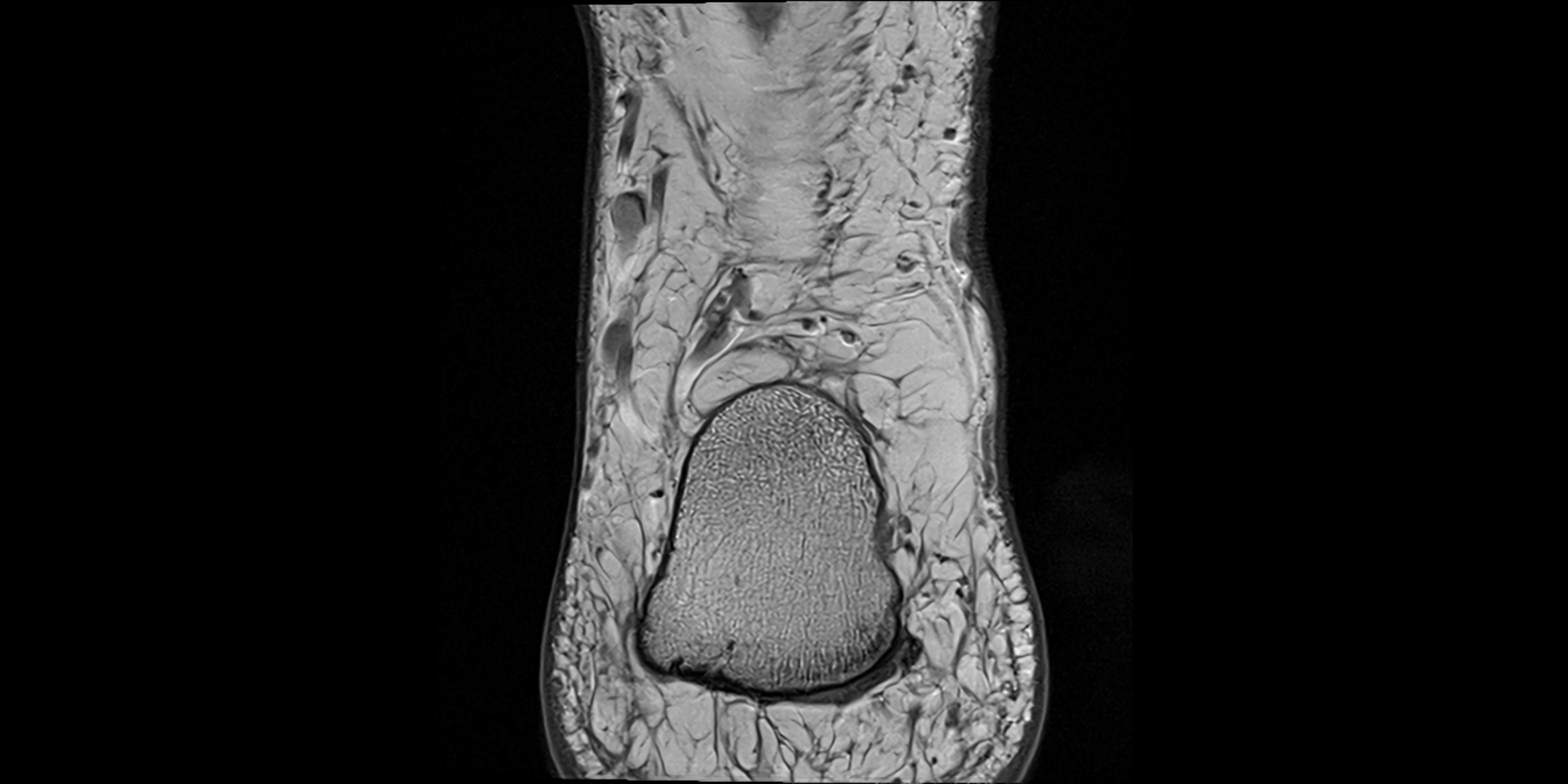 MRI Ankle coronal ligaments cross sectional anatomy 3T  radiology  image-img-00001-00026.webp